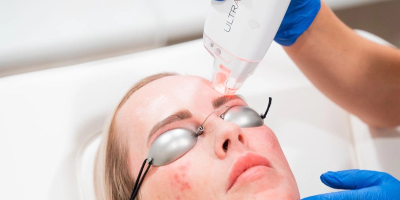 Laser Skin Resurfacing